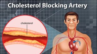 how to reduce Cholesterol: कोलेस्ट्रॉल कंट्रोल करने के लिए क्या करें