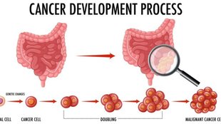 symptoms of bowel cancer,smoking and bowel cancer risk,reduce alcohol consumption,lifestyle changes to prevent bowel cancer,importance of hydration,high fibre diet,health risks of obesity,exercise for cancer prevention,early onset bowel cancer,