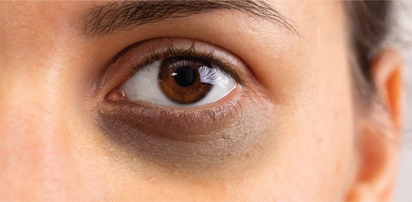 dark circles
