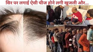 grow bald hair in meerut, meerut news