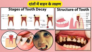 Signs of Tooth Decay: दांतों में सड़न के लक्षण