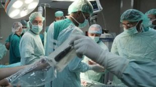 kidney transplant | albama |