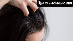 lemon for dandruff