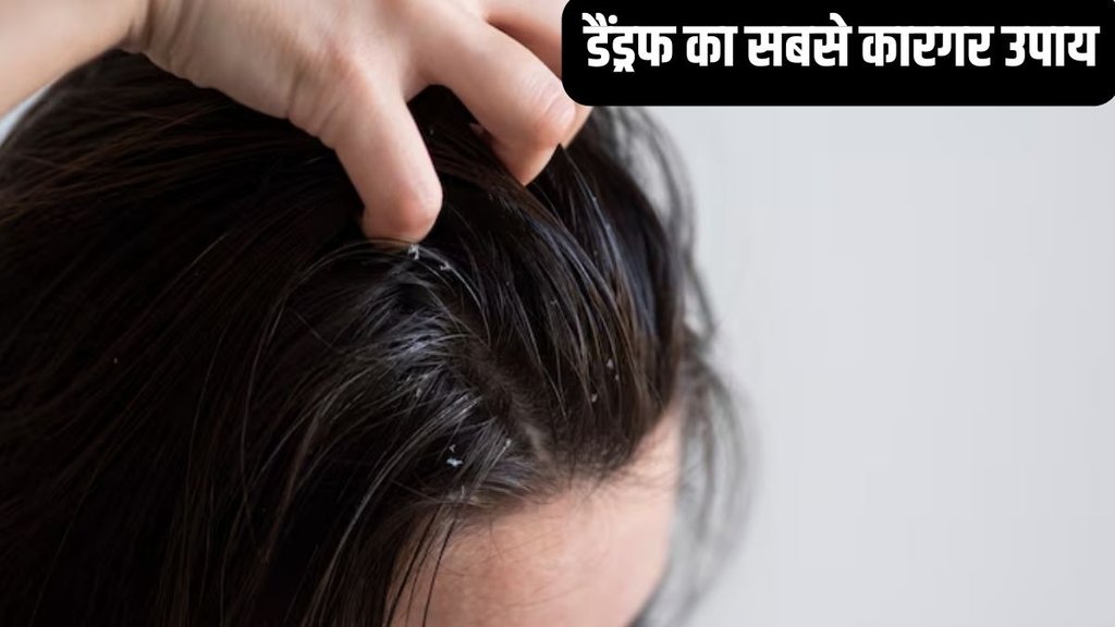 lemon for dandruff