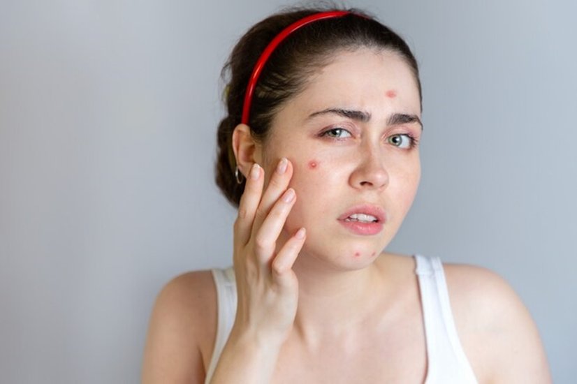 Acne solutions for healthy skin
