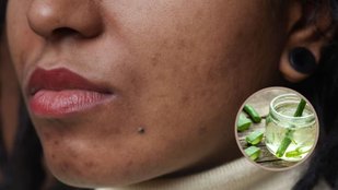 Aloe Vera for Dark Spots