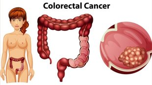 youth colon cancer,polyps and colon cancer,non-invasive cancer test,importance of cancer screening,early colon cancer detection
