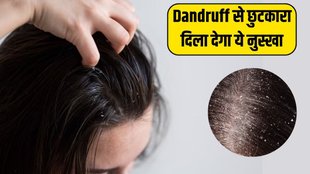 Dandruff । Dandruff Remedies । Dandruff treatment