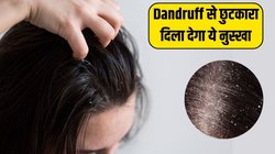 सिर में दूर से ही नजर आती है Dandruff की पपड़ी? दही में मिलाकर लगा लें ये एक चीज, एक्सपर्ट ने बताया कमाल का नुस्खा
