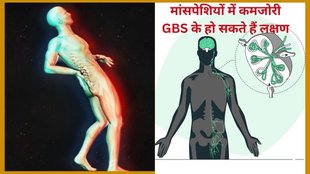 syndrome de guillain-barré, emg test guillain barre syndrome, Guillain-Barré Syndrome, pune,