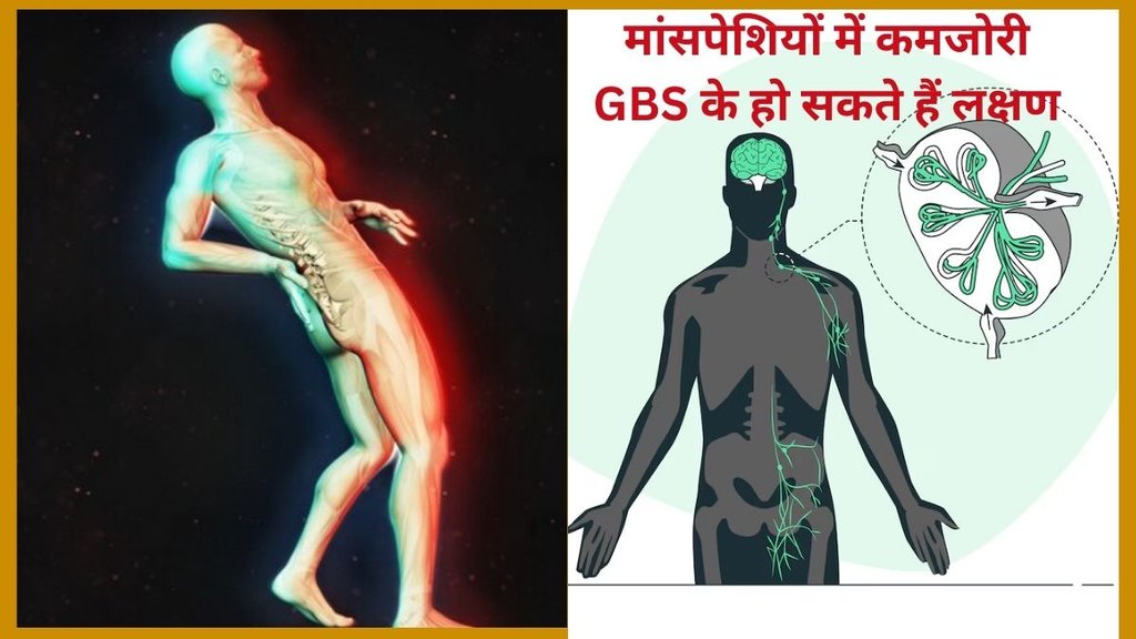 syndrome de guillain-barré, emg test guillain barre syndrome, Guillain-Barré Syndrome, pune,