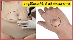 कैंसर की नहीं बल्कि चर्बी की भी होती है गांठ, आयुर्वेदिक नुस्खा ही कर देगा असर, चंद दिनों में घुल जाएगी गांठों की चर्बी