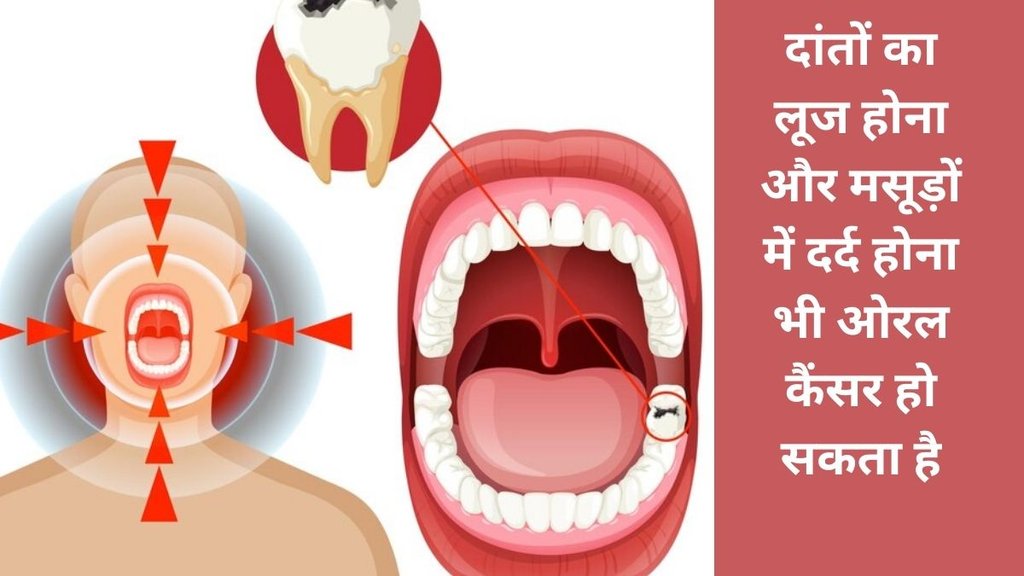 Mouth cancer early symptoms, Cancer, Health, mouth cancer, Mouth cancer, Mouth Cancer Symptoms, Oral Cancer Signs, Mouth Cancer Serious Symptoms,