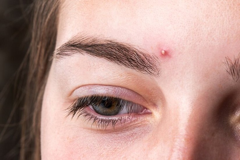 pimple on Eyebrows