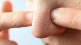 Acne and Whitehead Prevention