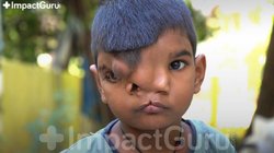 4 साल के श्रेयांश का दिमाग मस्तिष्क के बाहर बढ़ रहा है—उसका बचपन अधूरा रहने से बचाइए!