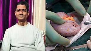 Rare Organ Transplant Cases