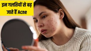 Acne Prone Skin । Acne remedy । how to get rid of acne