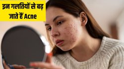 Acne Prone Skin है तो भूलकर न करें ये 3 गलतियां, स्किन की डॉक्टर ने बताया मुंहासों से भर जाएगा चेहरा