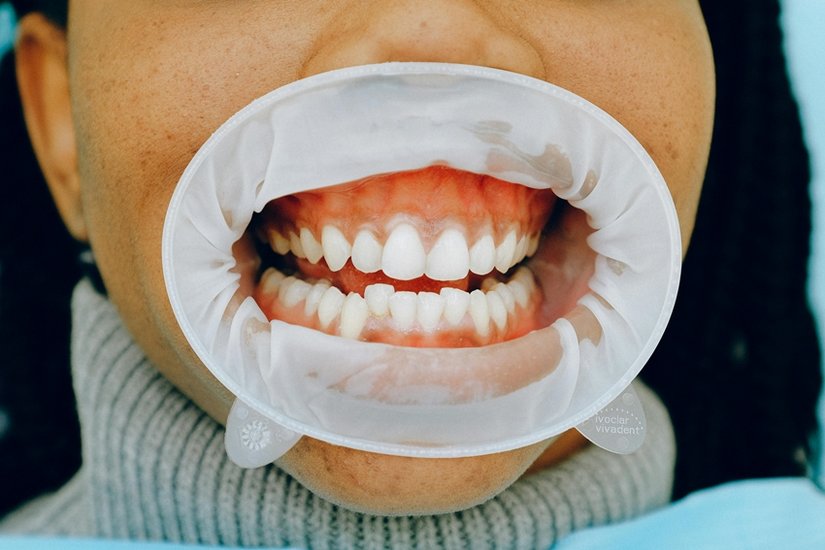does oil pulling work