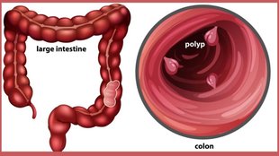juice cleanse hurting gut increasing inflammation,detoxification juice,gut health, detox body, fruits and vegetable juice,
