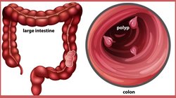 यह 1 डाइट आंतों में बढ़ा देती सूजन, गट में बलबलाने लगते हैं करोड़ों खतरनाक बैक्टीरिया, रिसर्च से जानिए कैसे