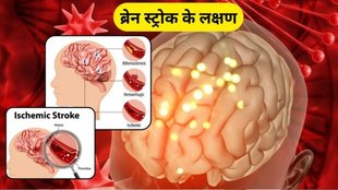 Brain Stroke kaise hota hai, Stroke kaise hota hai, Brain Stroke se kaise bachen, Brain Stroke ke karen, What to do to prevent brain stroke