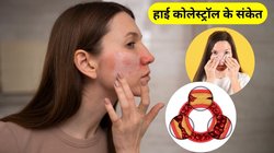 High Cholesterol: स्किन पर ही दिखाई दे जाते हैं हाई कोलेस्ट्रॉल के संकेत, नजरअंदाज करना तो हो सकता गंभीर, जानिए