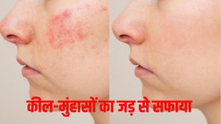pimple face । pimple on face