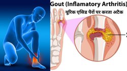 यूरिक एसिड हाई रहता है तो रोजाना 1 मुट्ठी इन 4 ड्राई फ्रूट को खा लें, जोड़ों का दर्द हो जाएगा दूर, सूजन से भी मिलेगी राहत