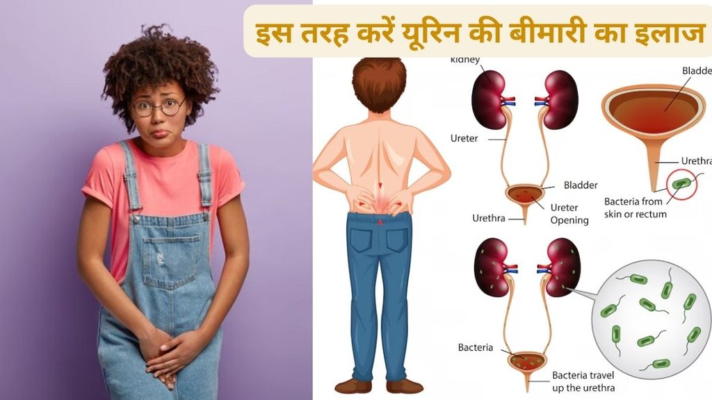 urination problems in males hindi, urination problems after turp surgery, urination problems after prostate removal