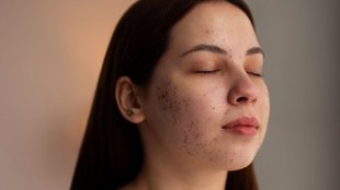 how to remove dark pigmentation