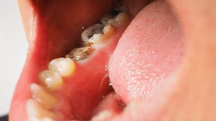 Best home remedies for oral hygiene