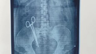 scissors left in woman stomach, scissors left in stomach during operation, scissors left during c-section