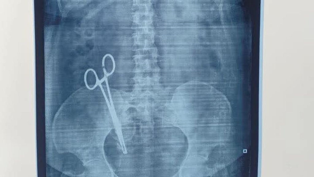 scissors left in woman stomach, scissors left in stomach during operation, scissors left during c-section