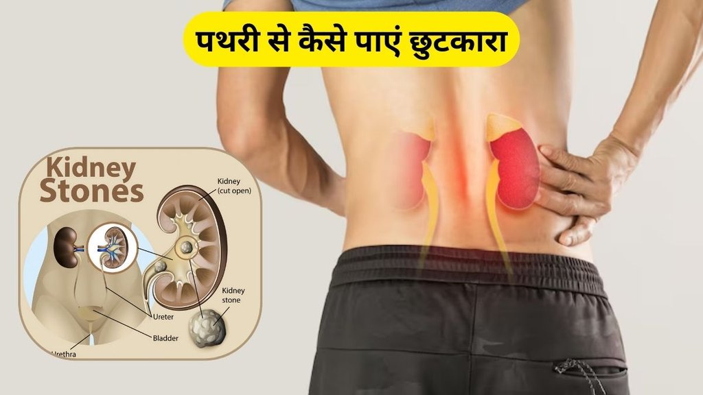best diet tips to prevent kidney stones, prevent kidney stones, kidney stones, best kidney stones prevent diet, kidney stones prevent diet, do not eat these foods kidney stones