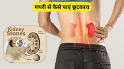 गुर्दे की पथरी से पाना चाहते हैं लाइफटाइम छुटकारा तो भूलकर भी मत खाना ये चीजें, एक्सपर्ट से जानिए
