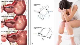 urinary retention in women symptoms, causes of urinary retention in females, urinary retention causes, itind, itind solution for urinary problems