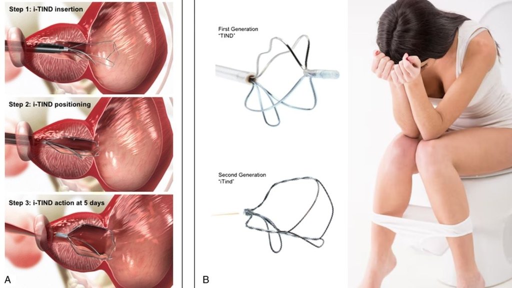 urinary retention in women symptoms, causes of urinary retention in females, urinary retention causes, itind, itind solution for urinary problems