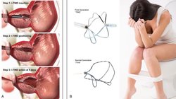 बार-बार पेशाब आता है तो अब हर 2 मिनट में नहीं जाना पड़ेगा बाथरूम? डॉक्टरों ने बनाई iTIND डिवाइस, जानिए कैसे करेगी काम
