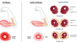 30 से 40 के बीच हर साल मांसपेशियां 1-2% होती हैं कम, इस बीमारी का बढ़ता है खतरा, एक्सपर्ट से जानिए कैसे करें बचाव