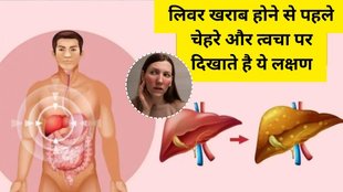 Causes of Fatty Liver, Fatty Liver Causes, Fatty Liver, Liver Causes, liver disease symptoms, Signs of liver damage start appearing on the face and skin, Signs of liver damage