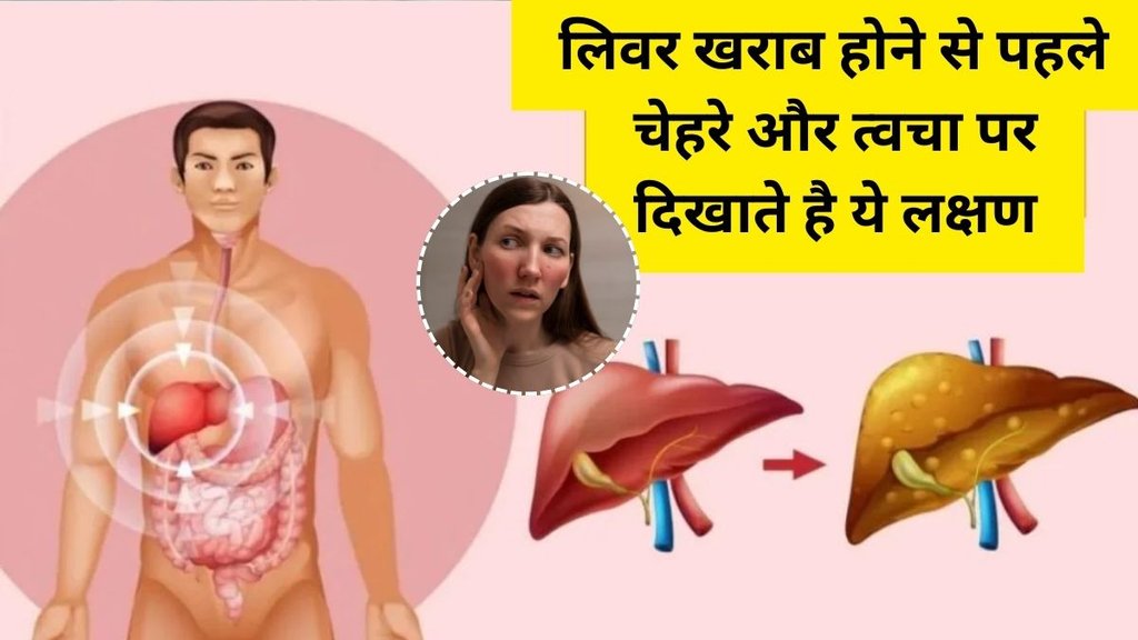 Causes of Fatty Liver, Fatty Liver Causes, Fatty Liver, Liver Causes, liver disease symptoms, Signs of liver damage start appearing on the face and skin, Signs of liver damage