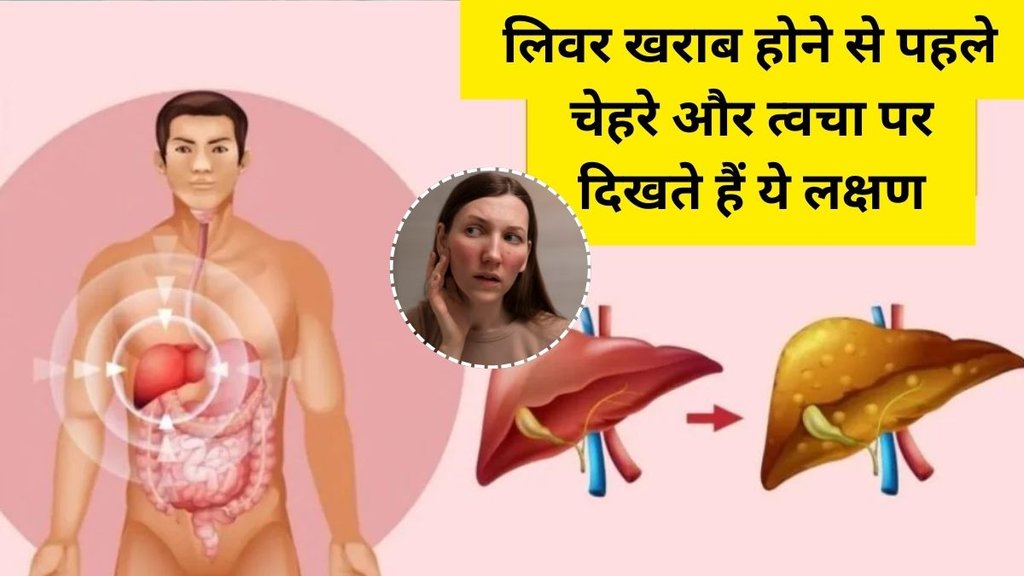 Causes of Fatty Liver, Fatty Liver Causes, Fatty Liver, Liver Causes, liver disease symptoms, Signs of liver damage start appearing on the face and skin, Signs of liver damage