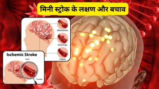 mini brain stroke kya hota hai, mini brain stroke, mini stroke, what is mini stroke, mini stroke signs, mini stroke symptoms, mini stroke treatment, transient ischemic attack