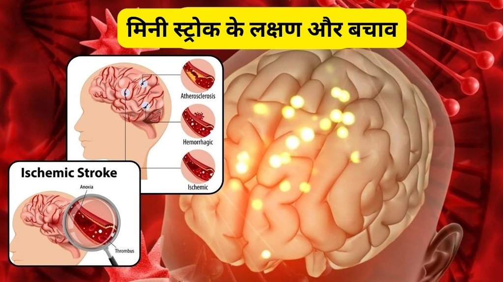 mini brain stroke kya hota hai, mini brain stroke, mini stroke, what is mini stroke, mini stroke signs, mini stroke symptoms, mini stroke treatment, transient ischemic attack