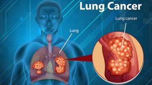lung cancer signs, lung cancer symptoms, symptoms of lung cancer, lung cancer ka ilaj, health news, health tips