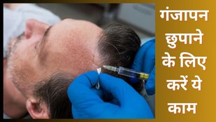 Male Pattern Baldness| Pattern hair loss | ganjapan