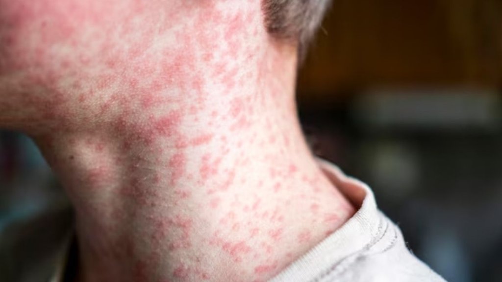 measles in children , measles symptoms in children , measles cause , measles in America , measles cases in USA , measles death in America