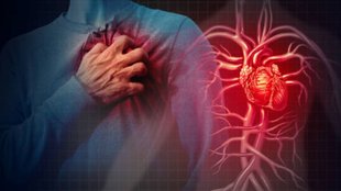 Minor Heart Attack, Non-ST Elevation Myocardial Infarction, Signs Of Minor Heart Attack, NSTEMI, Mini Heart Attack, Mini Heart Attack Symptoms